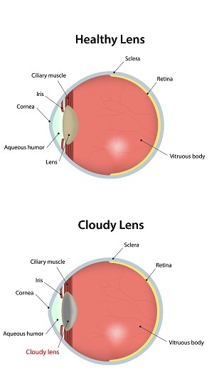 cataract-diagram